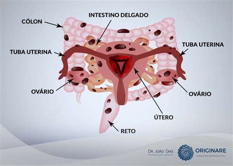 onde acontece a endometriose